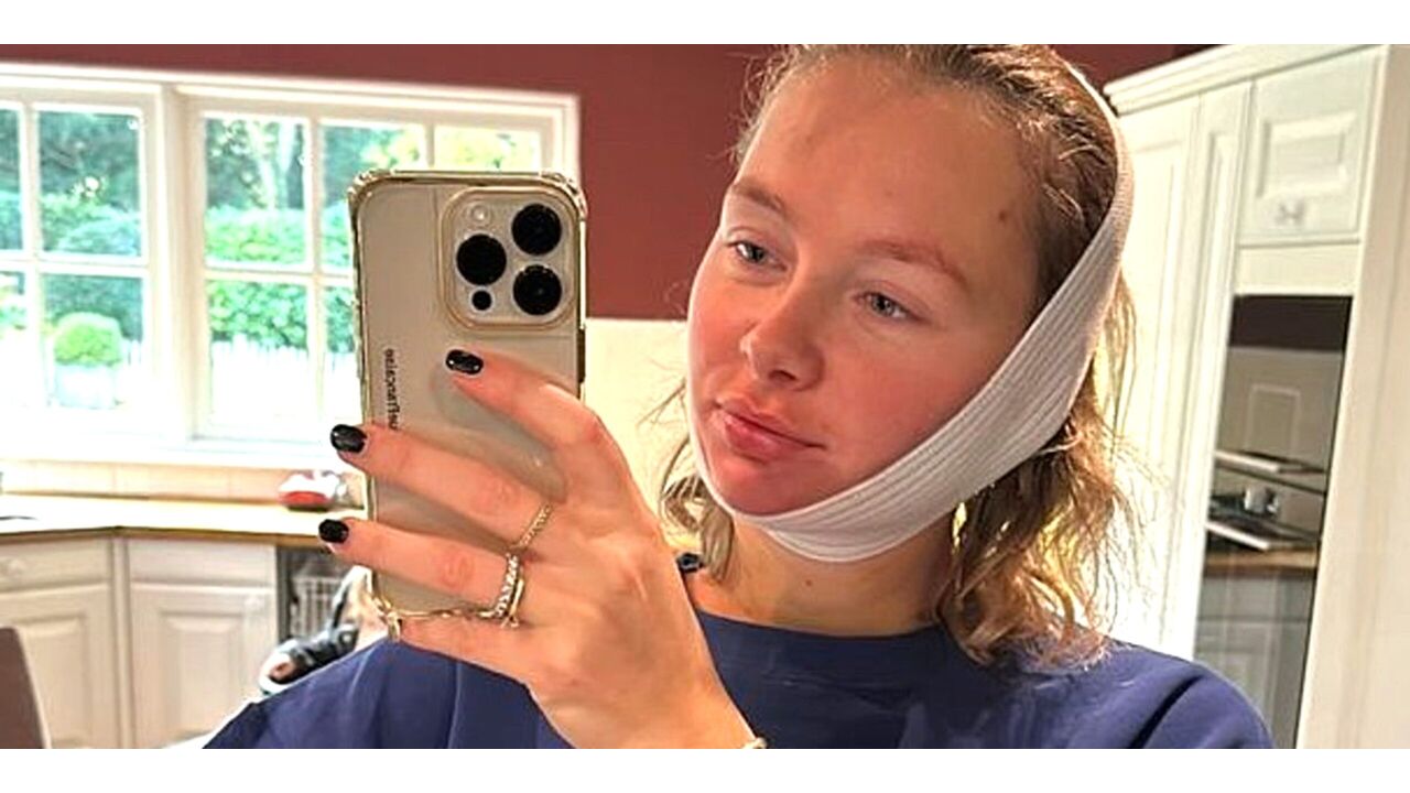 Illustratie voor: Zo ziet Maxime Meiland eruit na haar cosmetische ingreep